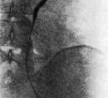Ретроперитонеалната фиброза (болест на Ормънд)