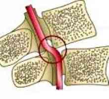 Синдром на гръбначния артерия