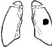 Белия дроб tuberculoma