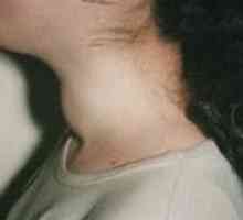 Нодуларна гуша (тироидните възли)