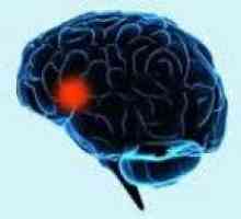 Темпорална епилепсия лоб