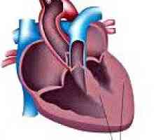 Вторичен кардиомиопатия