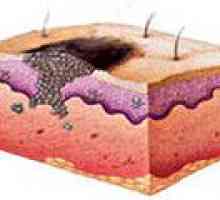 Злокачествените тумори на кожата