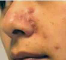 Стафилококус ауреус в носа