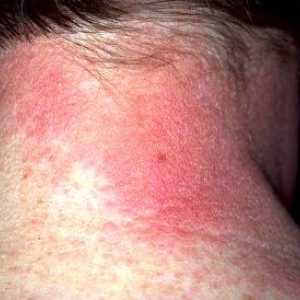 Алергичен дерматит: симптоми и лечение