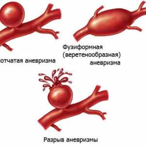 Бъбречната артерия аневризма