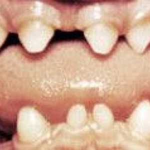 Аномалии на форма зъби