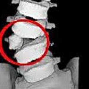 Аномалии на гръбначния стълб