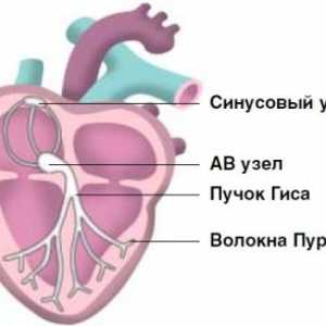 Сърце аритмия