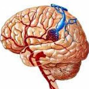 Артериовенозни малформации на мозъка
