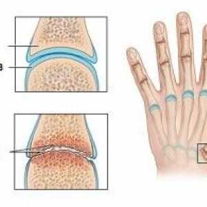 Артритни стави на пръстите на ръцете
