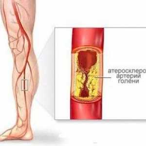 Атеросклерозата на долните крайници
