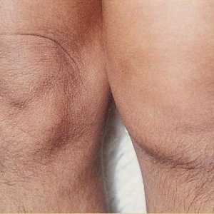 Болка в коляното (колянната става) на