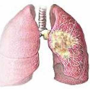 Централна рак на белия дроб