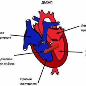 Камерни септален дефект на сърцето