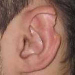 Деформацията на ушите