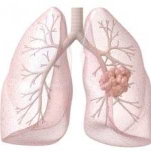 Диагностика и лечение на рак на белия дроб