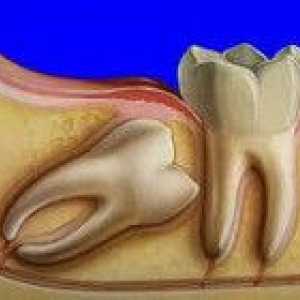 Дистопичния зъби