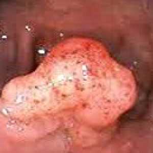 Доброкачествените тумори на дебелото черво