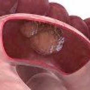 Доброкачествените тумори на тънките черва