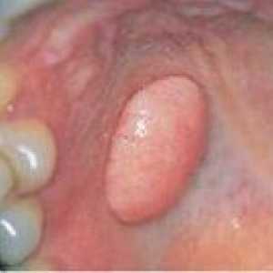 Fibroma устната