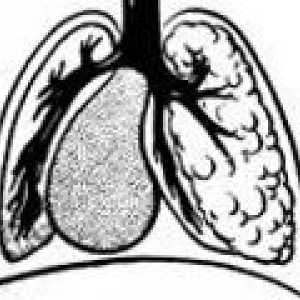 Хипоплазия на белите дробове