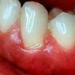 Хронично възпаление на венците