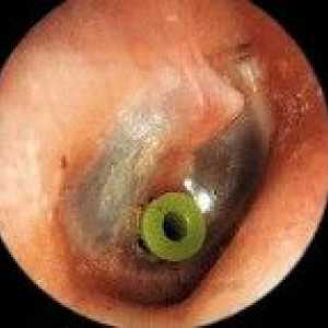Хронично възпаление на средното ухо с излив