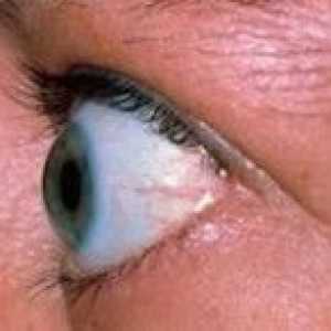 Ендокринна офталмопатия