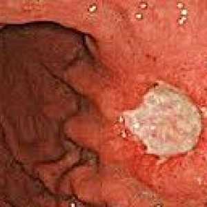 Карциноидни тумори на стомашно-чревния тракт