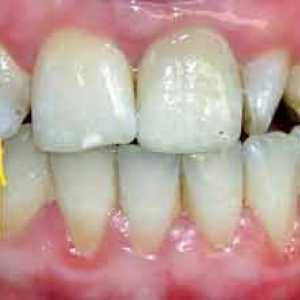 Кариес. Кариес на първични зъби при кърмачета