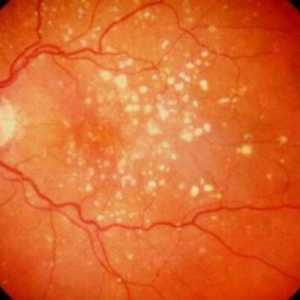 Каротеноидите при лечението на свързана с възрастта макулна дегенерация на ретината