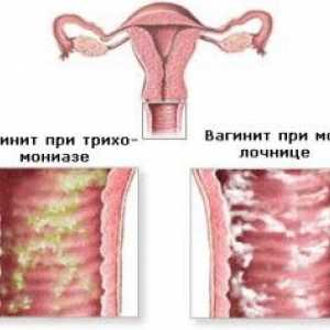 Coleitis (вагинит) при мъжете и жените