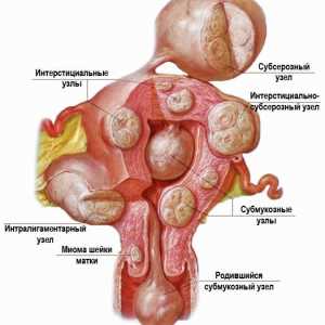 Hysteromyoma