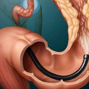 Тумор на дебелото черво: Симптомите