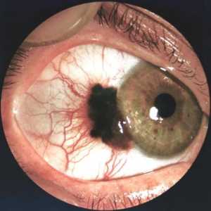 Тумори на окото