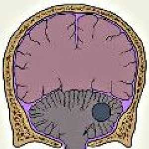 Тумори на малкия мозък