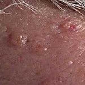Тумори на мастните жлези