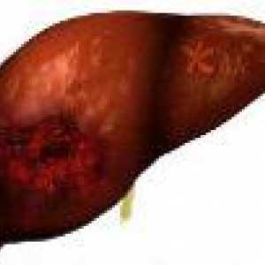 Рак на черния дроб