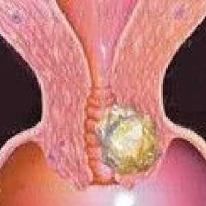 Повторната поява на рак на маточната шийка