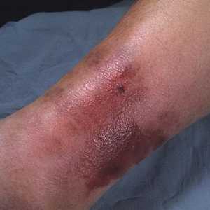 Еризипел крака: симптоми и лечение