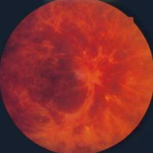 Венозна тромбоза на ретината