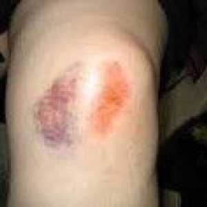 Травма на коляното