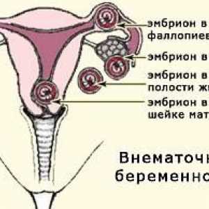 Извънматочна бременност