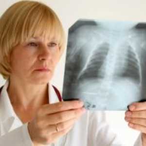 СЗО предупреждава за връщането на туберкулоза
