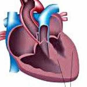 Вторичен кардиомиопатия