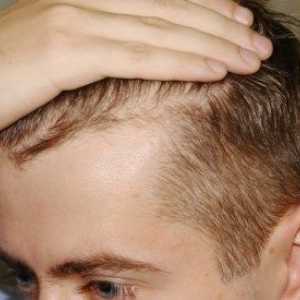 Загубата на коса при мъжете: причини, лечение, средство